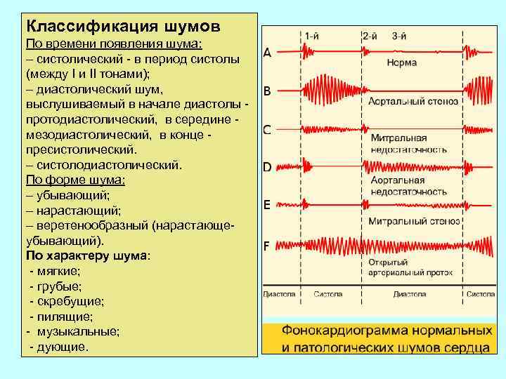 Классификация шумов По времени появления шума: – систолический - в период систолы (между I