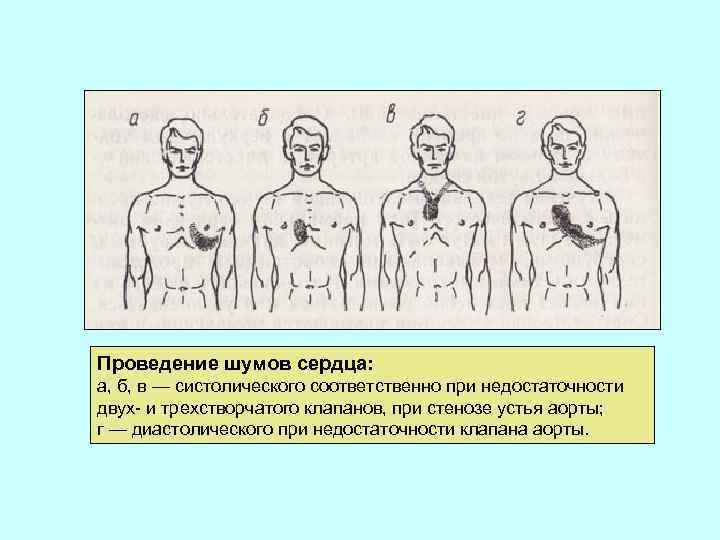 Проведение шумов сердца: а, б, в — систолического соответственно при недостаточности двух- и трехстворчатого