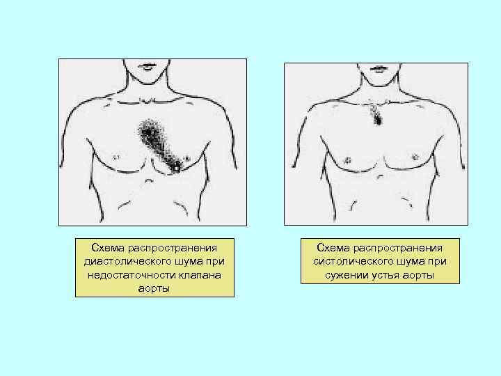 Схема распространения диастолического шума при недостаточности клапана аорты Схема распространения систолического шума при сужении