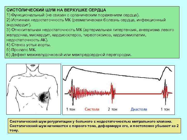 СИСТОЛИЧЕСКИЙ ШУМ НА ВЕРХУШКЕ СЕРДЦА 1) Функциональный (не связан с органическим поражением сердца). 2)