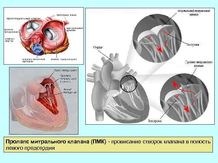 Дополнительная хорда митрального клапана