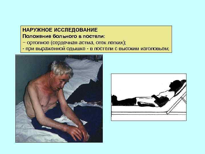 НАРУЖНОЕ ИССЛЕДОВАНИЕ Положение больного в постели: − ортопное (сердечная астма, отек легких); - при