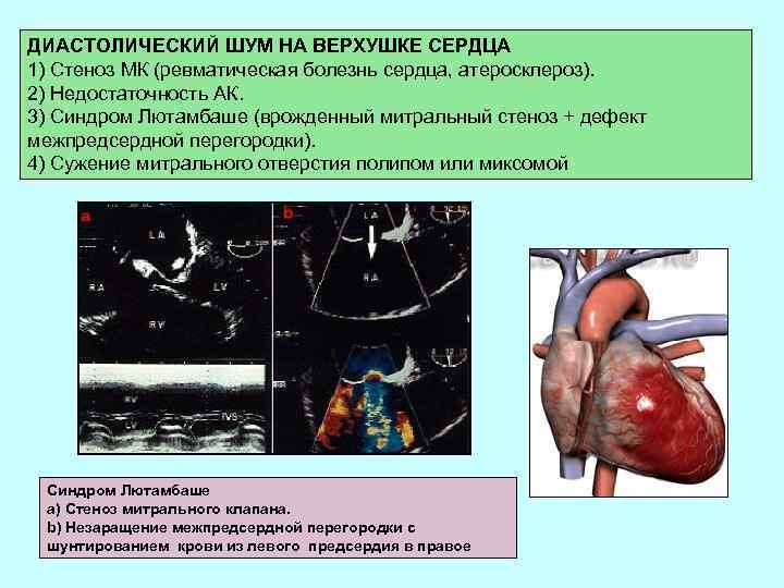 ДИАСТОЛИЧЕСКИЙ ШУМ НА ВЕРХУШКЕ СЕРДЦА 1) Стеноз МК (ревматическая болезнь сердца, атеросклероз). 2) Недостаточность