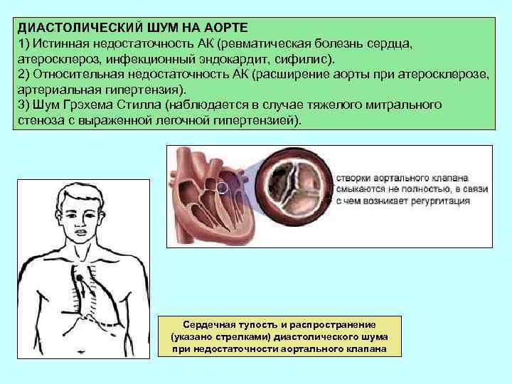 ДИАСТОЛИЧЕСКИЙ ШУМ НА АОРТЕ 1) Истинная недостаточность АК (ревматическая болезнь сердца, атеросклероз, инфекционный эндокардит,