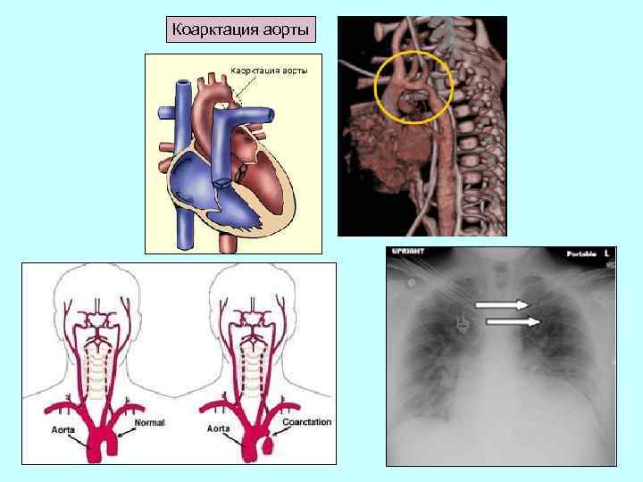 Коарктация аорты фото