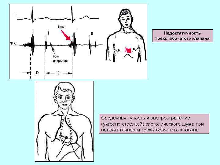 Недостаточность клапана операция. Недостаточность трикуспидального клапана шум. Трикуспидальная недостаточность ФКГ. Синдром поражения трикуспидального клапана. ФКГ при недостаточности трехстворчатого клапана.