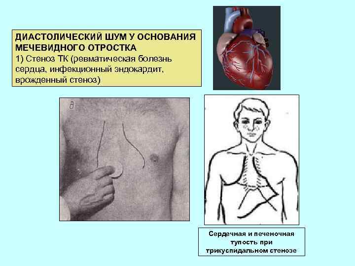 ДИАСТОЛИЧЕСКИЙ ШУМ У ОСНОВАНИЯ МЕЧЕВИДНОГО ОТРОСТКА 1) Стеноз ТК (ревматическая болезнь сердца, инфекционный эндокардит,