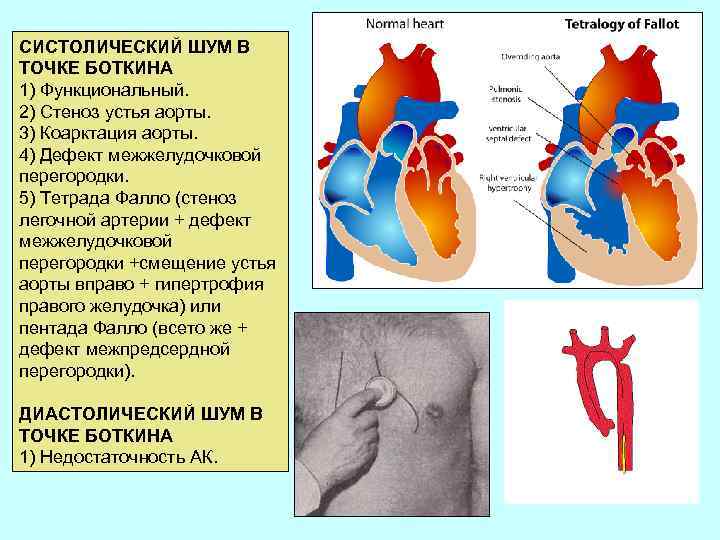 СИСТОЛИЧЕСКИЙ ШУМ В ТОЧКЕ БОТКИНА 1) Функциональный. 2) Стеноз устья аорты. 3) Коарктация аорты.