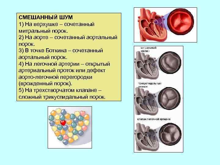 СМЕШАННЫЙ ШУМ 1) На верхушке – сочетанный митральный порок. 2) На аорте – сочетанный