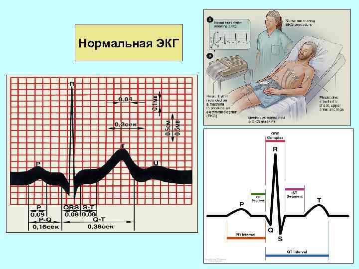 Нормальная ЭКГ 