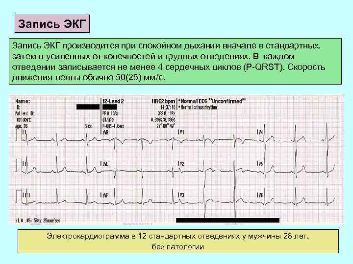 Запись ЭКГ производится при спокойном дыхании вначале в стандартных, затем в усиленных от конечностей