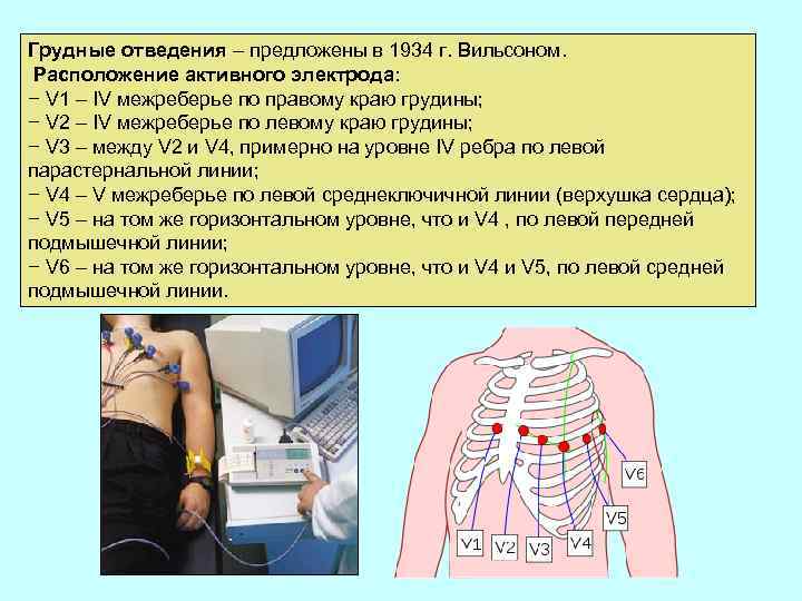 Грудные отведения – предложены в 1934 г. Вильсоном. Расположение активного электрода: − V 1