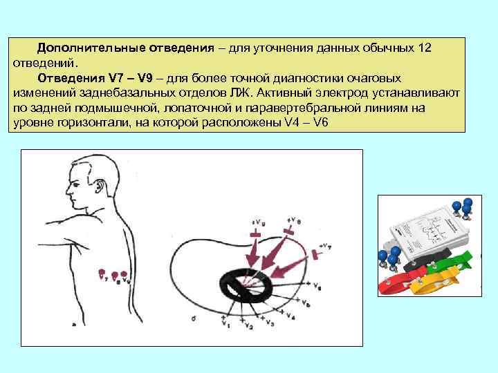 Дополнительные отведения – для уточнения данных обычных 12 отведений. Отведения V 7 – V