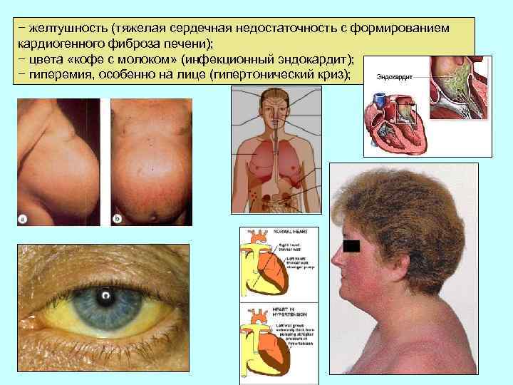 − желтушность (тяжелая сердечная недостаточность с формированием кардиогенного фиброза печени); − цвета «кофе с