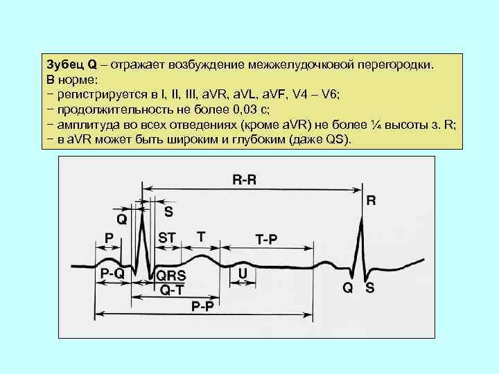 Для патологического зубца q характерно. Зубец q в v4- v6. Патологический зубец q в v1 v2 v3. ЭКГ им v4-v6 зубец q. Зубец q на ЭКГ В норме.