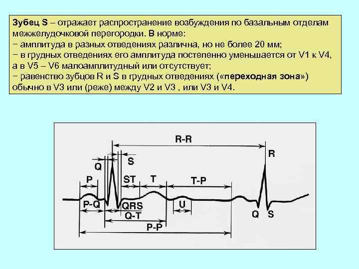 Зубец S – отражает распространение возбуждения по базальным отделам межжелудочковой перегородки. В норме: −