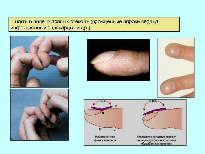 − ногти в виде «часовых стекол» (врожденные пороки сердца, инфекционный эндокардит и др. ).