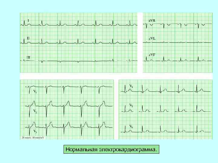 Нормальная электрокардиограмма. 