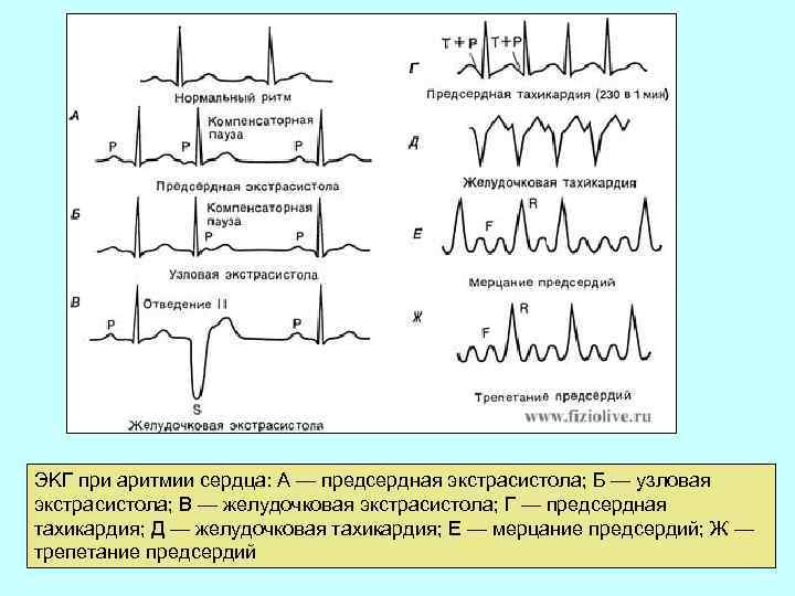 ЭKГ при аритмии сердца: А — предсердная экстрасистола; Б — узловая экстрасистола; В —
