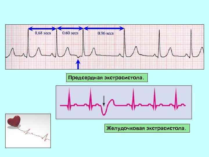 Предсердная экстрасистола. Желудочковая экстрасистола. 