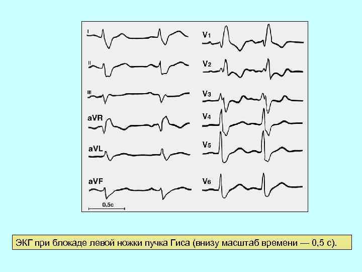 ЭКГ при блокаде левой ножки пучка Гиса (внизу масштаб времени — 0, 5 с).