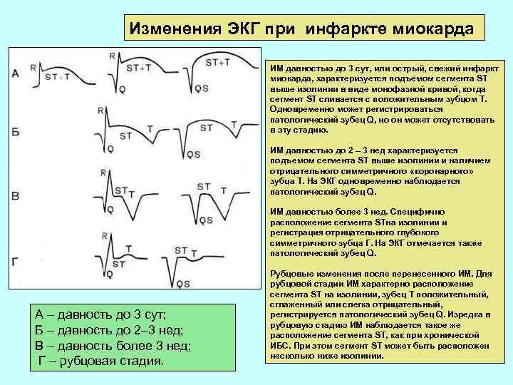 Изменения ЭКГ при инфаркте миокарда ИМ давностью до 3 сут, или острый, свежий инфаркт