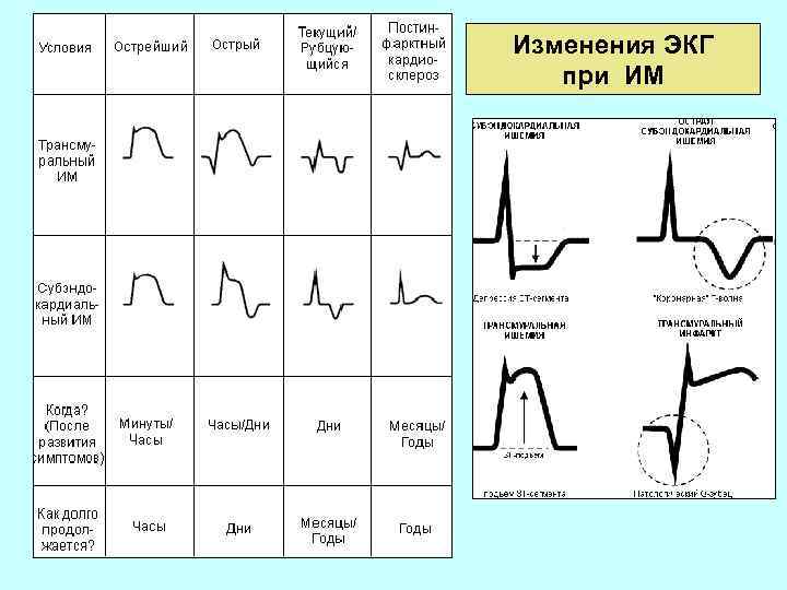 Изменения ЭКГ при ИМ 