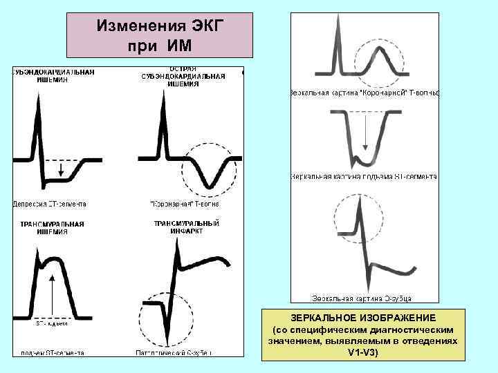 Изменения ЭКГ при ИМ ЗЕРКАЛЬНОЕ ИЗОБРАЖЕНИЕ (со специфическим диагностическим значением, выявляемым в отведениях V