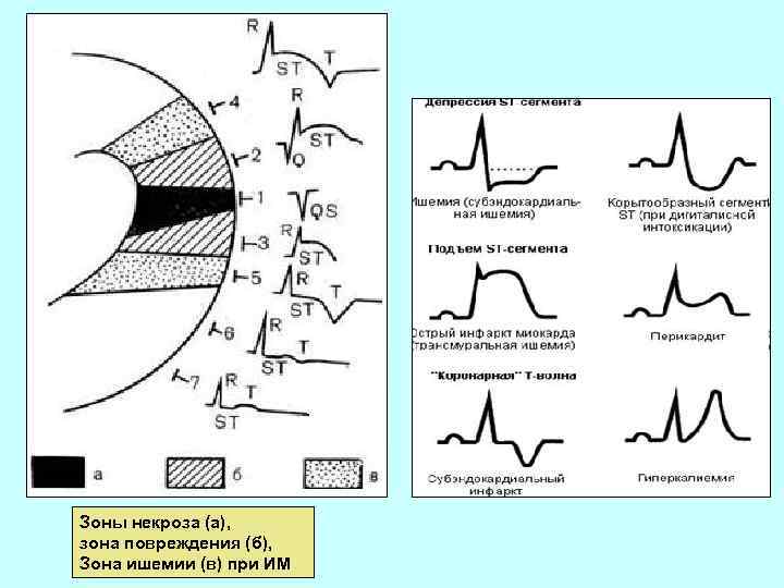 Зоны некроза (а), зона повреждения (б), Зона ишемии (в) при ИМ 