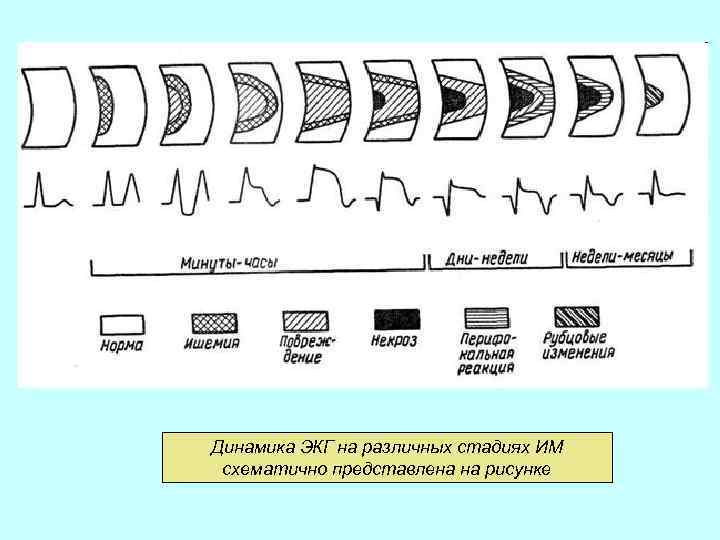 Динамика ЭКГ на различных стадиях ИМ схематично представлена на рисунке 