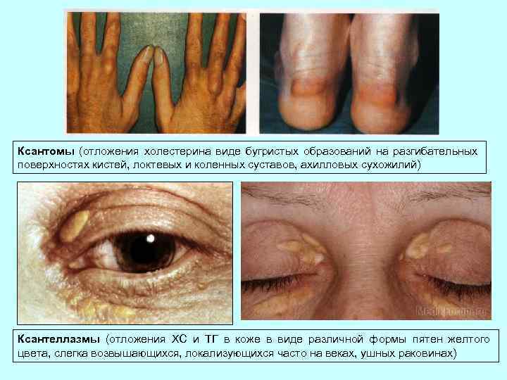 Ксантомы (отложения холестерина виде бугристых образований на разгибательных поверхностях кистей, локтевых и коленных суставов,