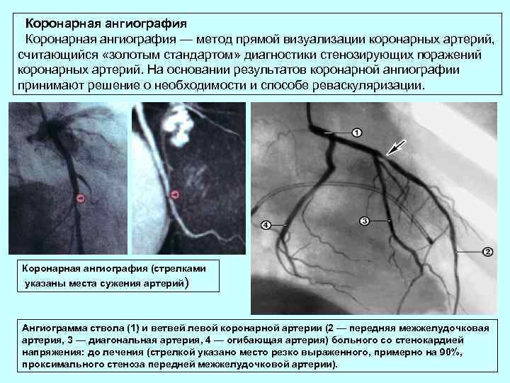 Коронарная ангиография — метод прямой визуализации коронарных артерий, считающийся «золотым стандартом» диагностики стенозирующих поражений