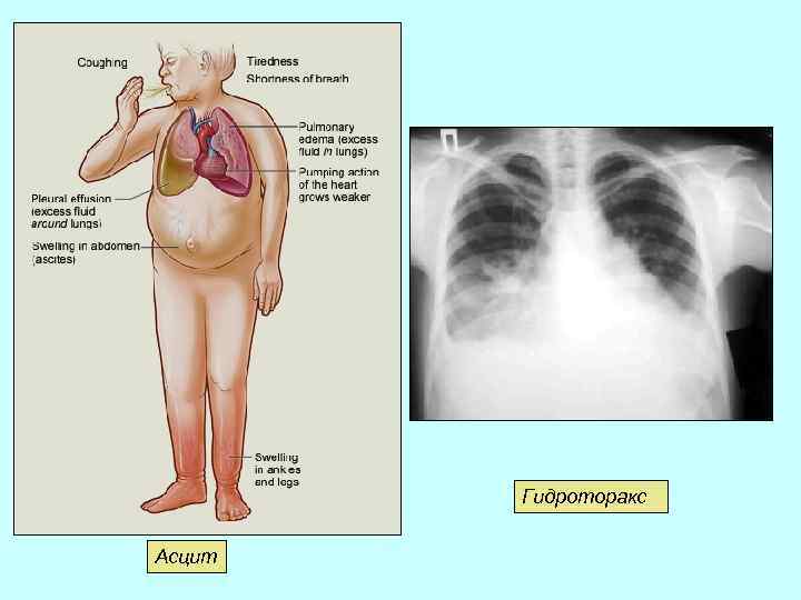 Гидроторакс отек. Сердечная недостаточность гидроторакс. Гидроторакс механизм возникновения. Асцит гидроторакс гидроперикард.