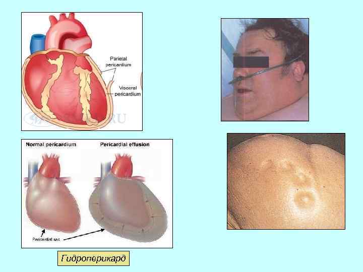 Гидроперикард 