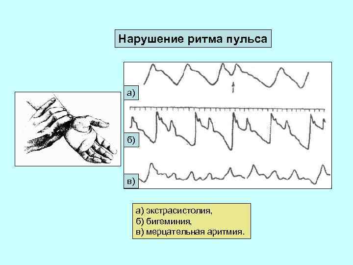 Нарушение ритма пульса а) б) в) а) экстрасистолия, б) бигеминия, в) мерцательная аритмия. 