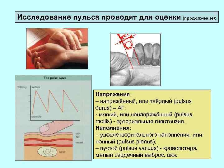 Исследование пульса проводят для оценки (продолжение): Напряжения: – напряжённый, или твёрдый (pulsus durus) –