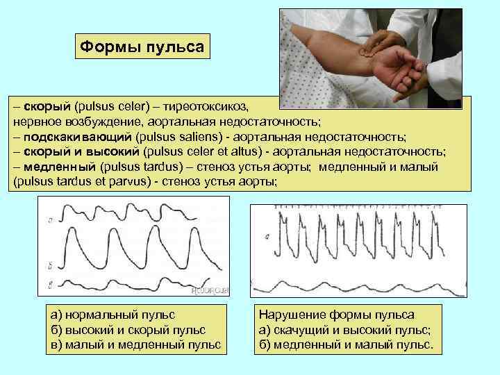 Скорый пульс. Форма пульса. Виды пульса. Пульс виды пульса. Форма пульса в норме.