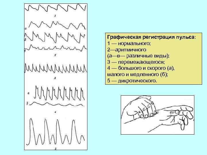 Графическая регистрация пульса: 1 — нормального; 2—аритмичного (а—в— различные виды); 3 — перемежающегося; 4