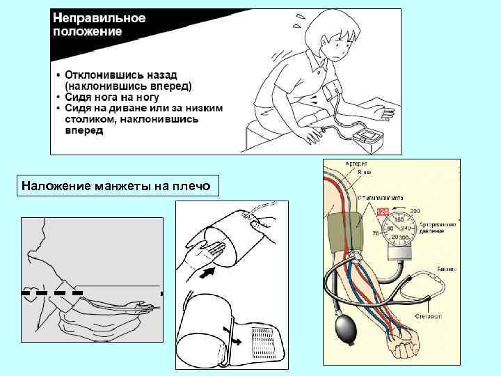 Наложение манжеты на плечо 