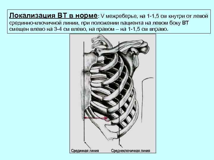 Локализация ВТ в норме: V межреберье, на 1 -1, 5 см кнутри от левой