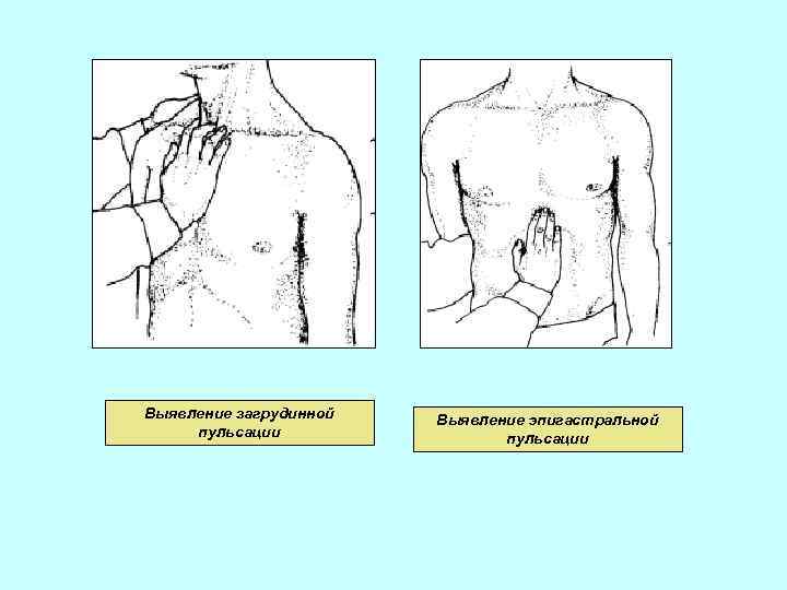 Выявление загрудинной пульсации Выявление эпигастральной пульсации 