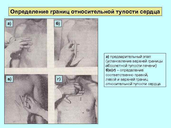 Определение границ относительной тупости сердца а) в) б) г) а) предварительный этап (установление верхней