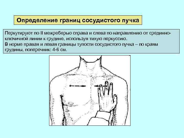 Определение границ сосудистого пучка Перкутируют по II межреберью справа и слева по направлению от