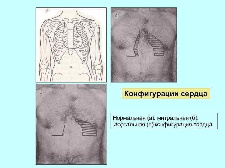 Аортальная конфигурация сердца схема