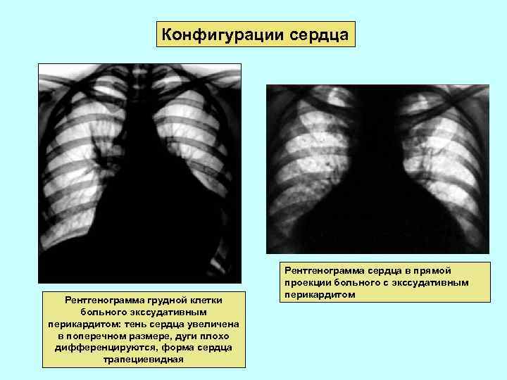 Конфигурации сердца Рентгенограмма грудной клетки больного экссудативным перикардитом: тень сердца увеличена в поперечном размере,