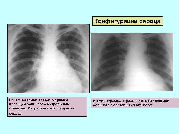 Конфигурации сердца Рентгенограмма сердца в прямой проекции больного с митральным стенозом. Митральная конфигурация сердца