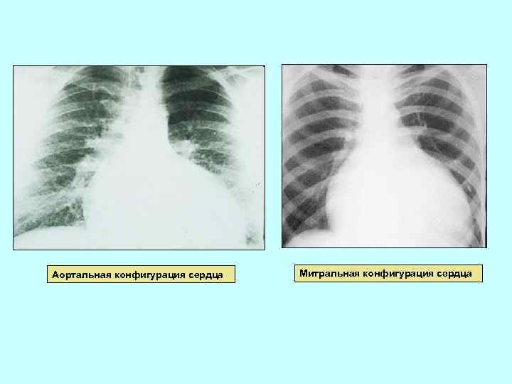 Аортальная конфигурация сердца Митральная конфигурация сердца 
