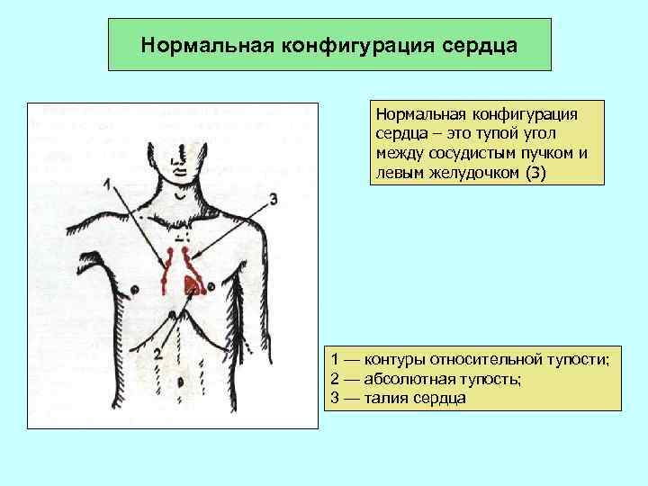 Нормальная конфигурация сердца – это тупой угол между сосудистым пучком и левым желудочком (3)