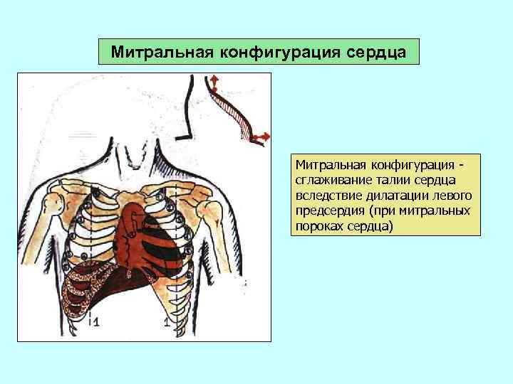 Митральная конфигурация сердца Митральная конфигурация сглаживание талии сердца вследствие дилатации левого предсердия (при митральных