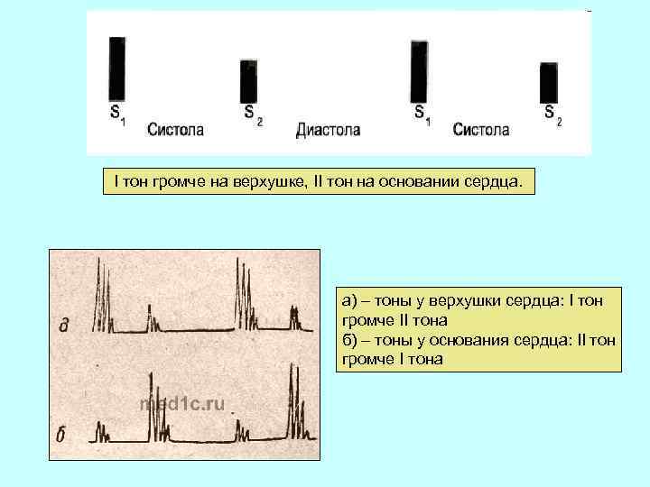  I тон громче на верхушке, II тон на основании сердца. а) – тоны